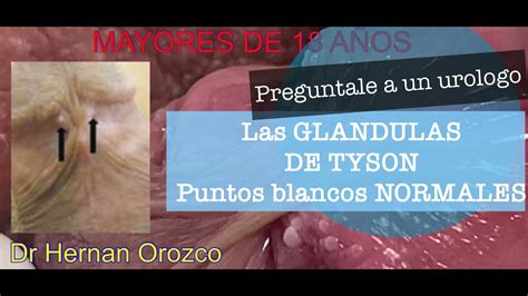 que son las glandulas de tyson|Pápulas perladas (glándulas de Tyson): qué son y。